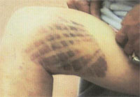 kinesio_bruise