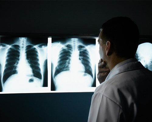 Lung-cancer-screening