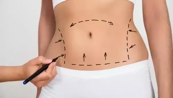 liposuction-liposculpture