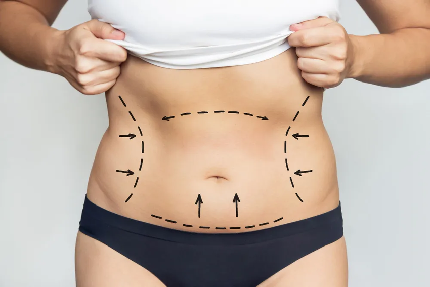 What-is-Liposuction