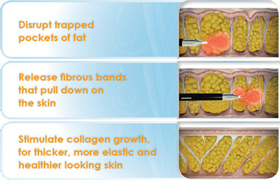 laser-cellulite-procedure